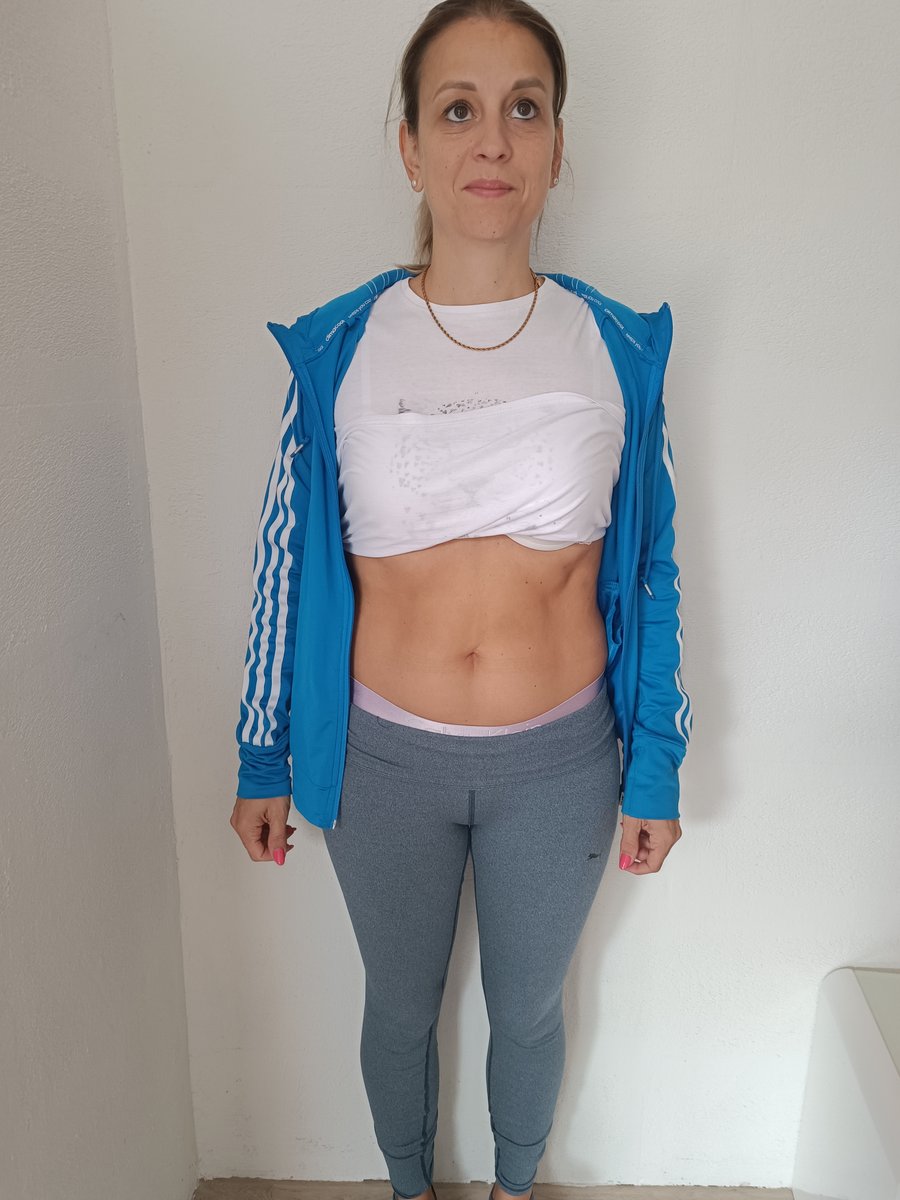 Serbanescu nach der EM-Bodyshaper nach der EM-Bodyshaper Behandlung
